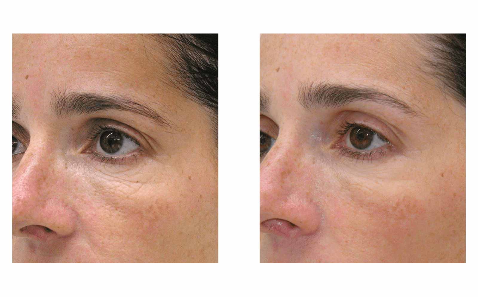 Mesotherapy for face Fulham London - Pure Skin Beauty Clinc
