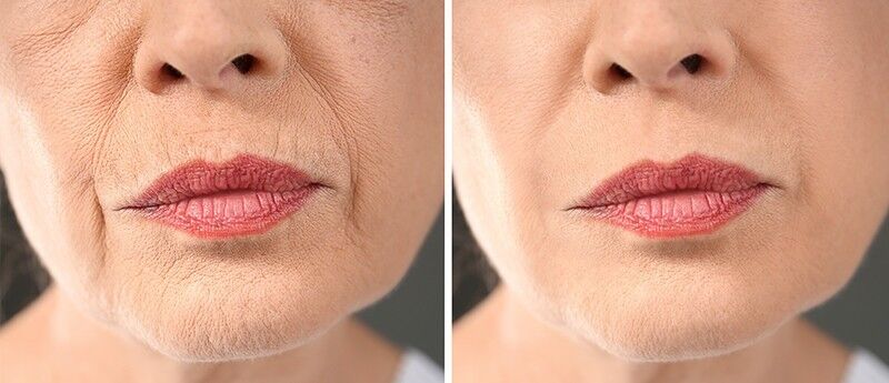 Mesotherapy for face Fulham London | Pure Skin Beauty Clinc