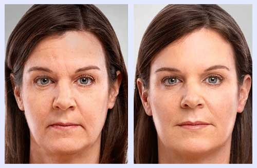 Mesotherapy for face Fulham London | Pure Skin Beauty Clinc