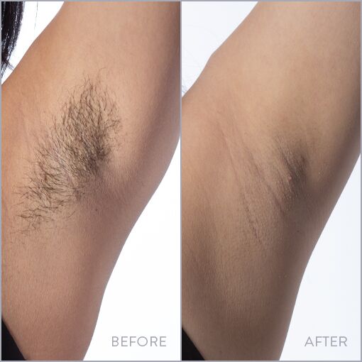 Underarm hair laser removal cost discount